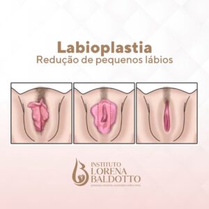 labioplastia