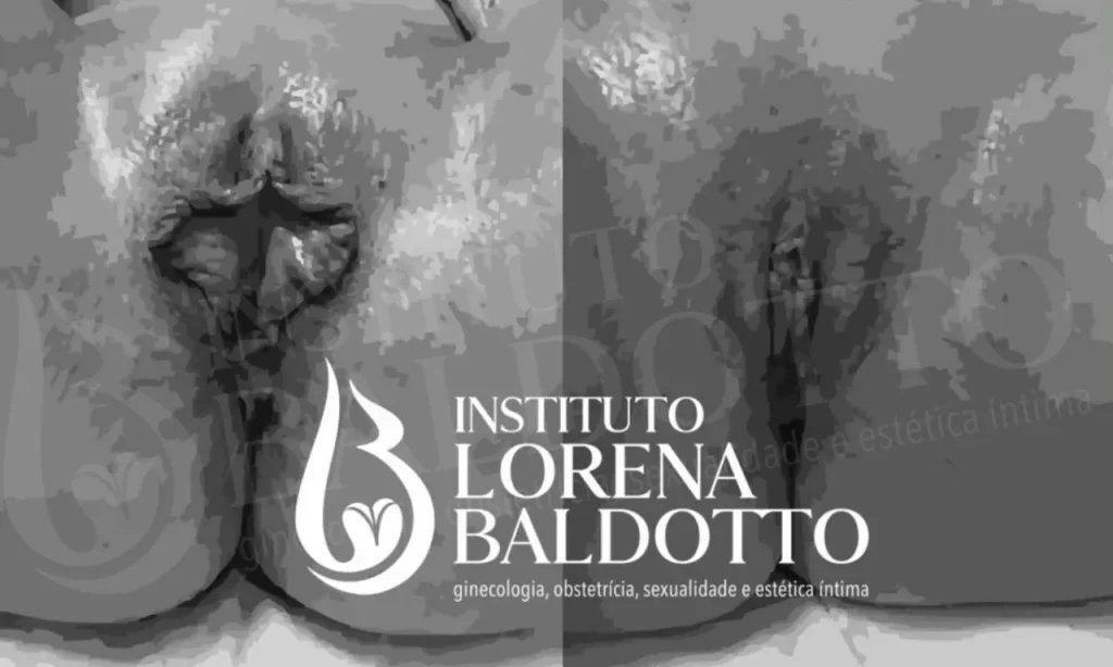 Cirurgia Íntima 1 Ninfoplastia - Dra. Lorena Simões Baldotto
