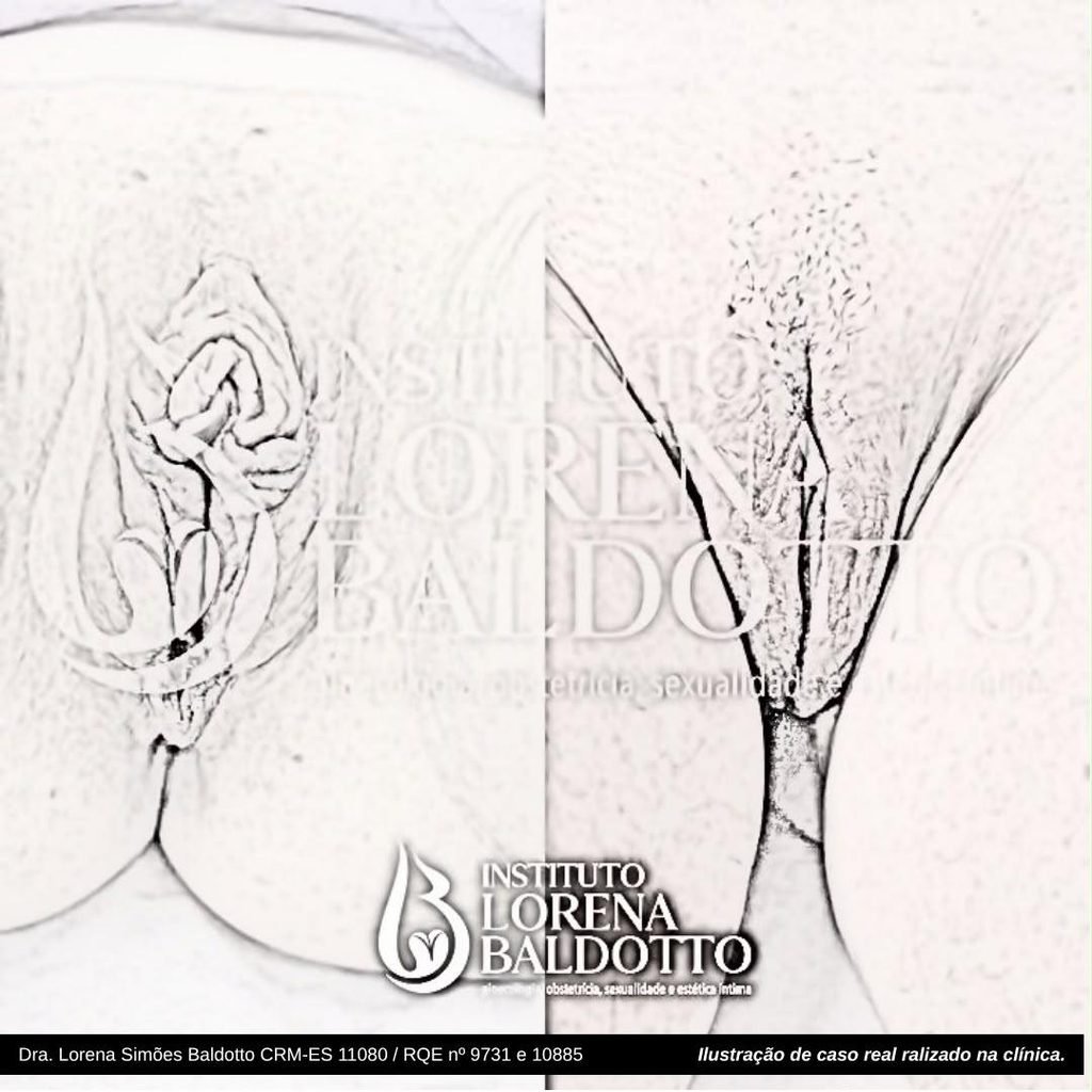 Cirurgia Íntima 7 ClitoroplastiaNinfoEscultura - Dra. Lorena Simões Baldotto