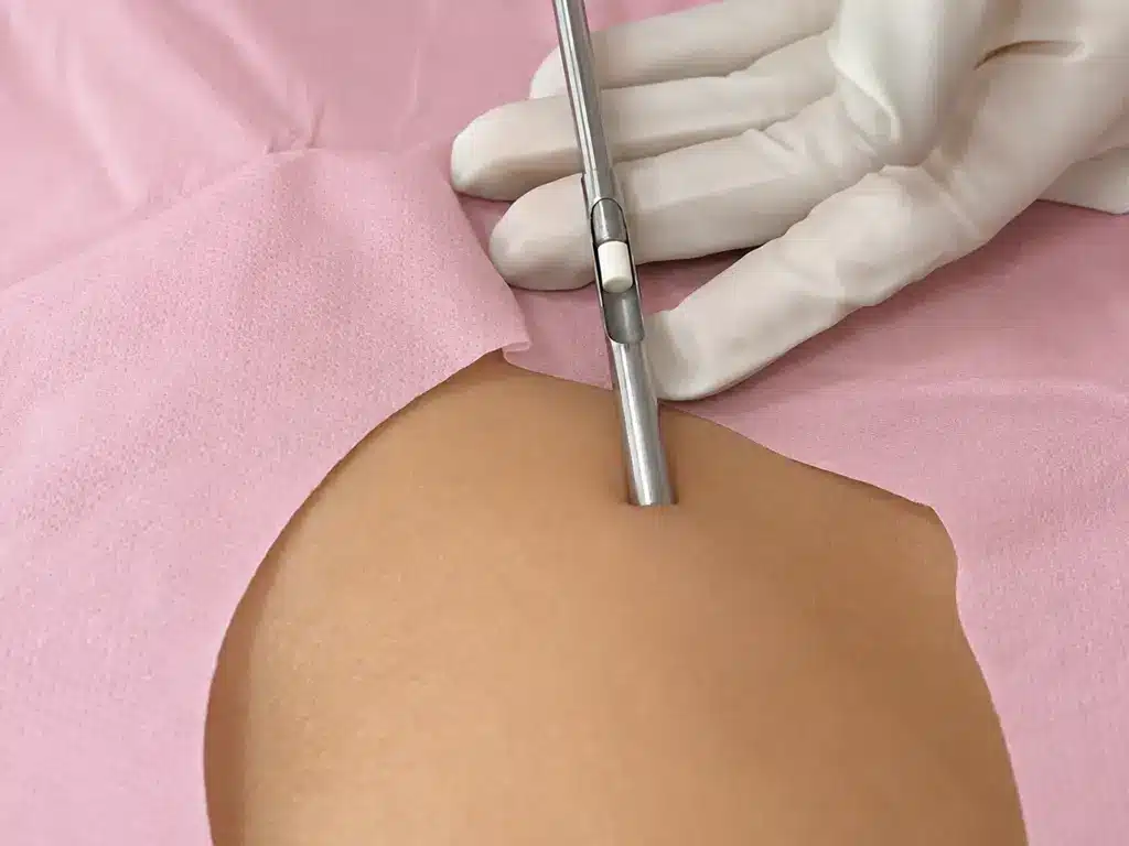 Reposição Hormonal 9 IMPLANTE HORMONAL
