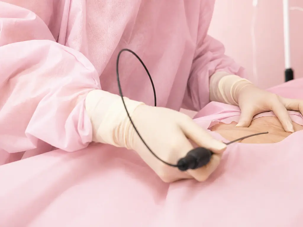 Mini lipo para monte de Vênus 15 LIPO MONTE DE VENUS