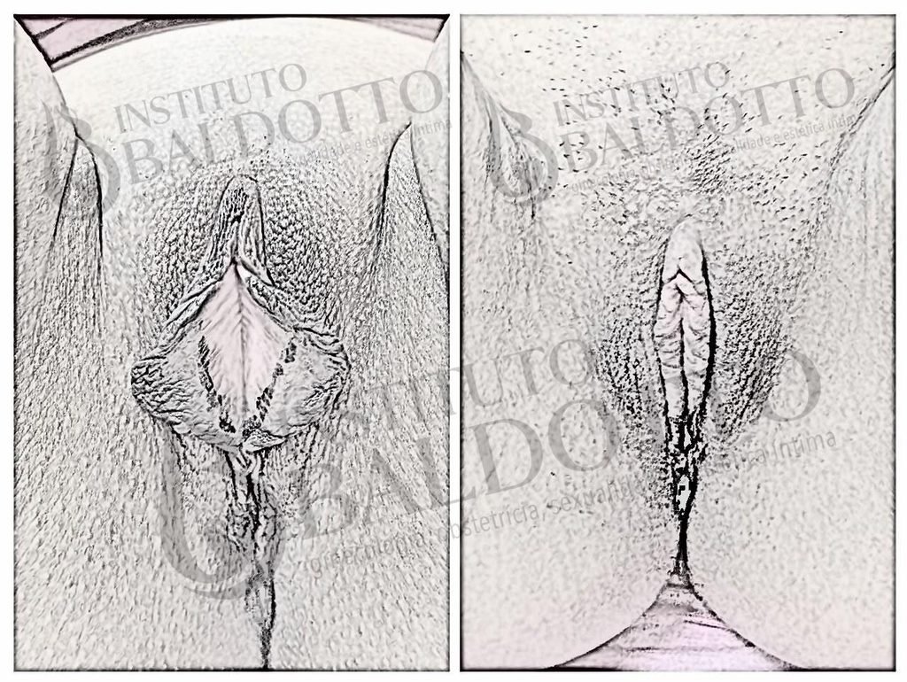 Cirurgia Íntima 2 Ninfoplastia - Dra. Lorena Simões Baldotto