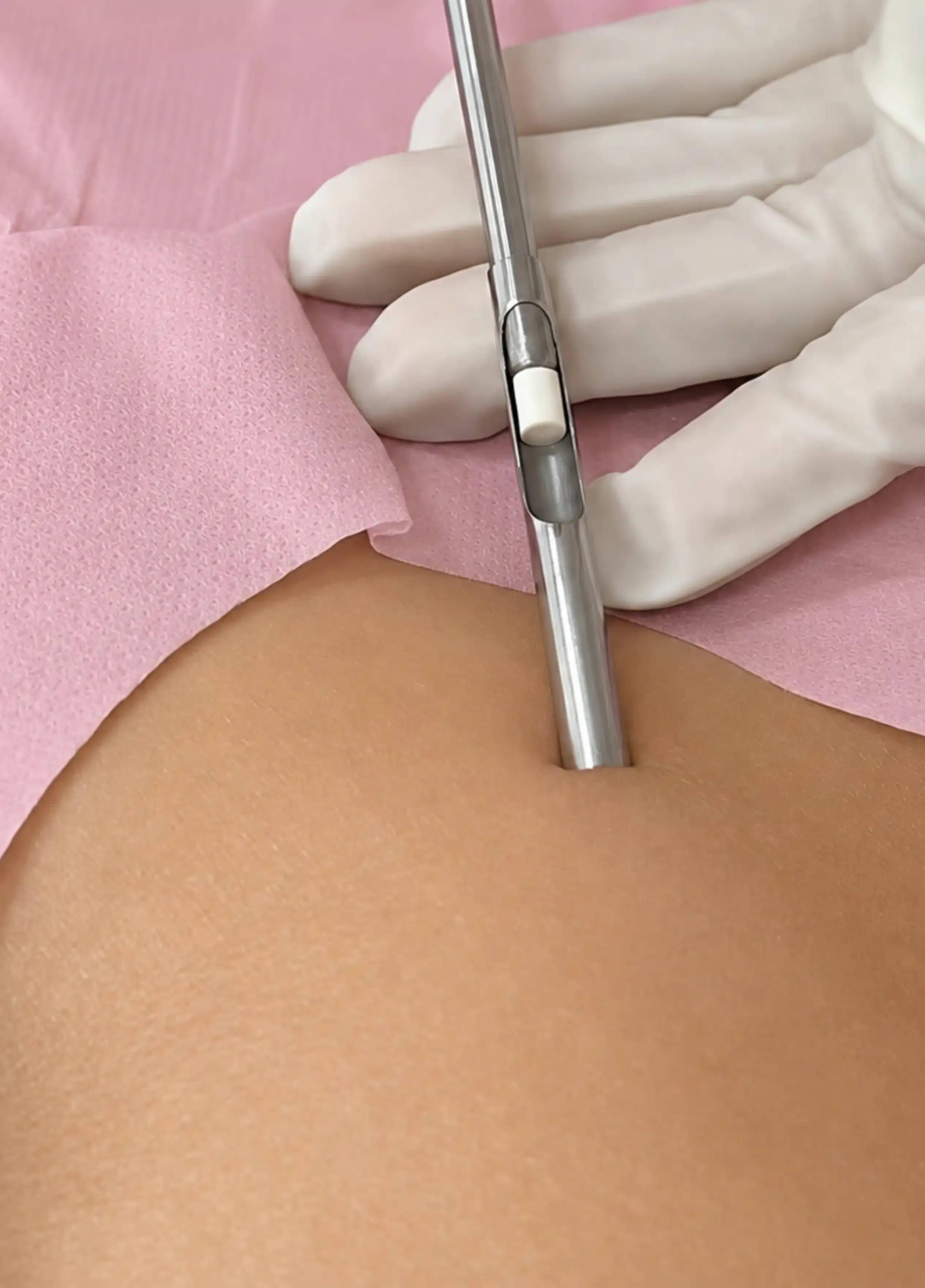 Reposição Hormonal 9 IMPLANTE HORMONAL