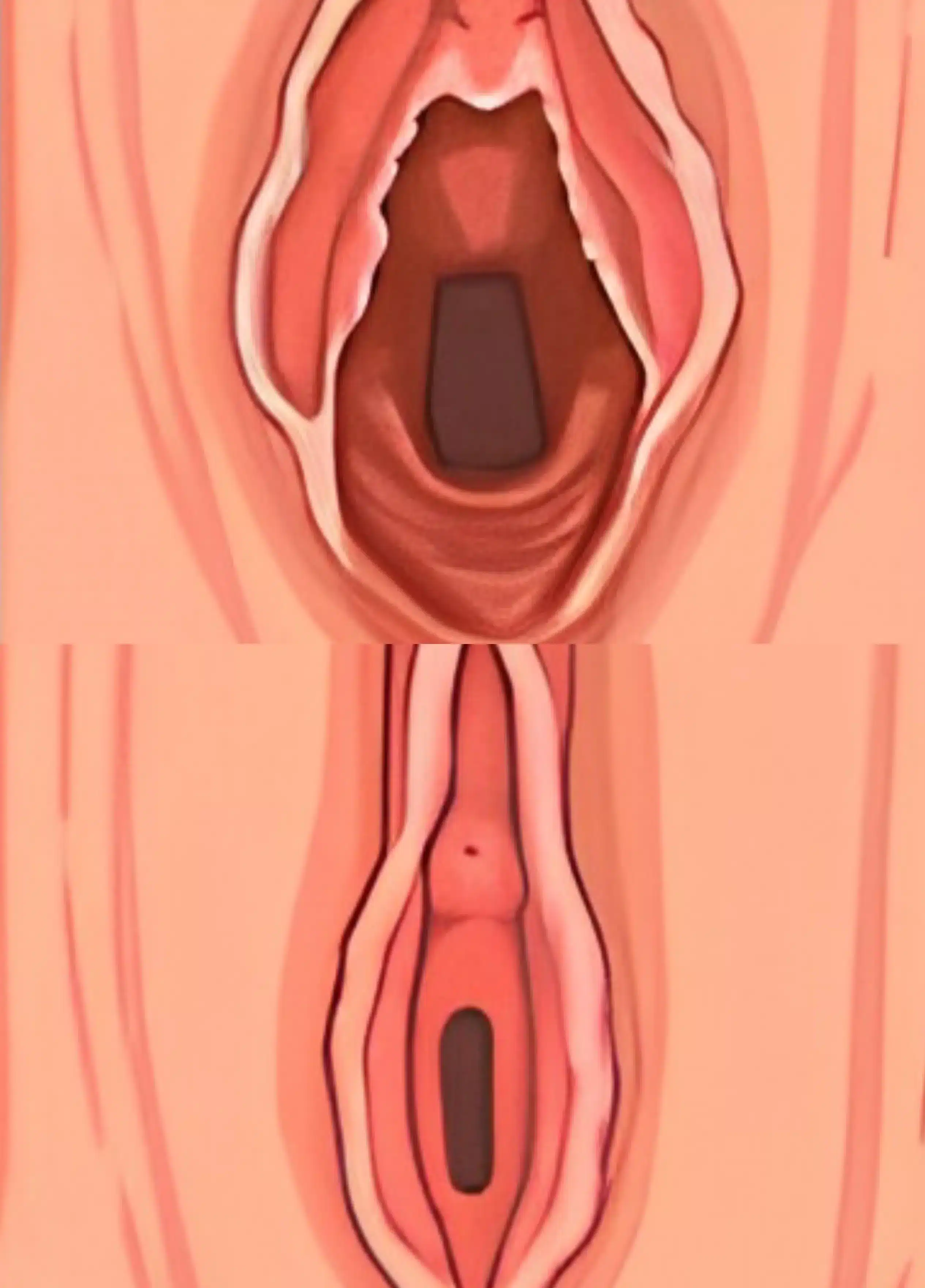 Procedimentos 4 PERINEOPLASTIA